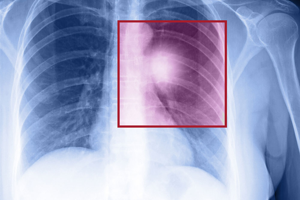 Lung Cancer and its Treatments